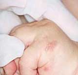 Herpès néonatal sur la main